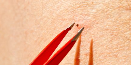 Jede entfernte Zecke ist eine gute Zecke